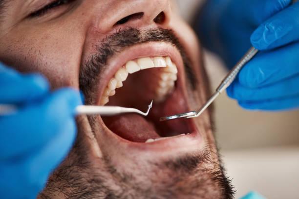 Best Wisdom Tooth Removal  in North Puyallup, WA